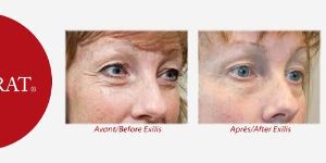 Soin Exilis Elite pour les yeux