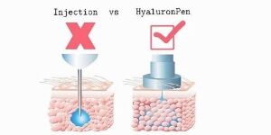 Applicable sur traitement stylo acide hyaluronique (Lèvres et comblements)