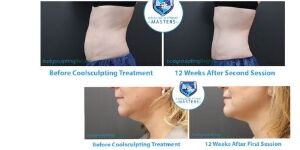 Body Sculpting Regina Body Sculpting in Regina