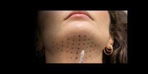 St-Laurent Médico-Esthétique Chèque-cadeau électronique pour des injections